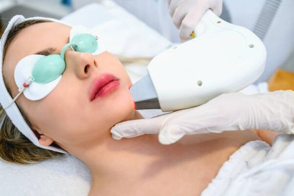 лазерна процедура за подмладяване на кожата на лицето