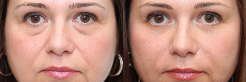 Преди и след блефаропластика - премахване на мастното тяло под очите и стягане на кожата