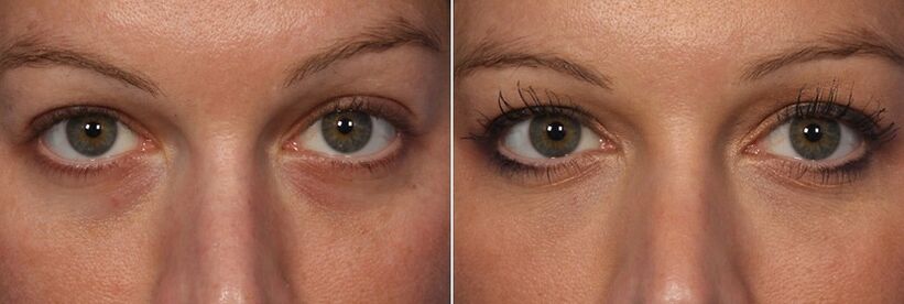 Преди и след използване на инжекционни филъри - намаляване на кръговете под очите