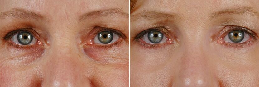 Преди и след лазерна хирургия - подмладяване на кожата около очите